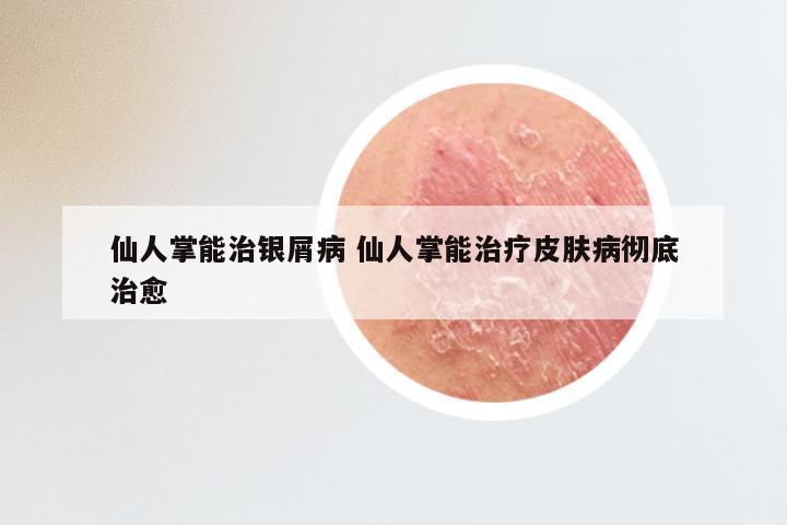 仙人掌能治银屑病 仙人掌能治疗皮肤病彻底治愈