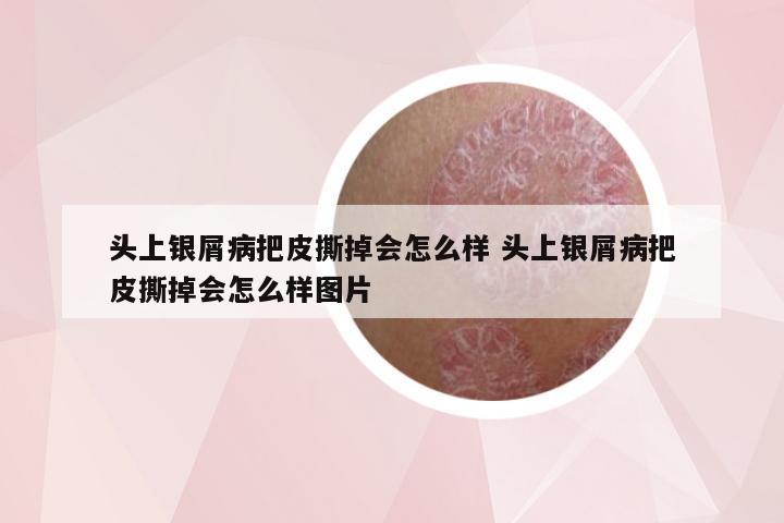 头上银屑病把皮撕掉会怎么样 头上银屑病把皮撕掉会怎么样图片