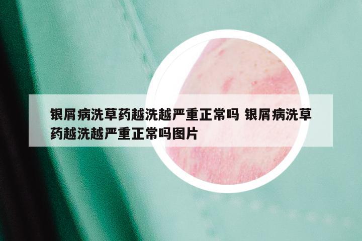 银屑病洗草药越洗越严重正常吗 银屑病洗草药越洗越严重正常吗图片