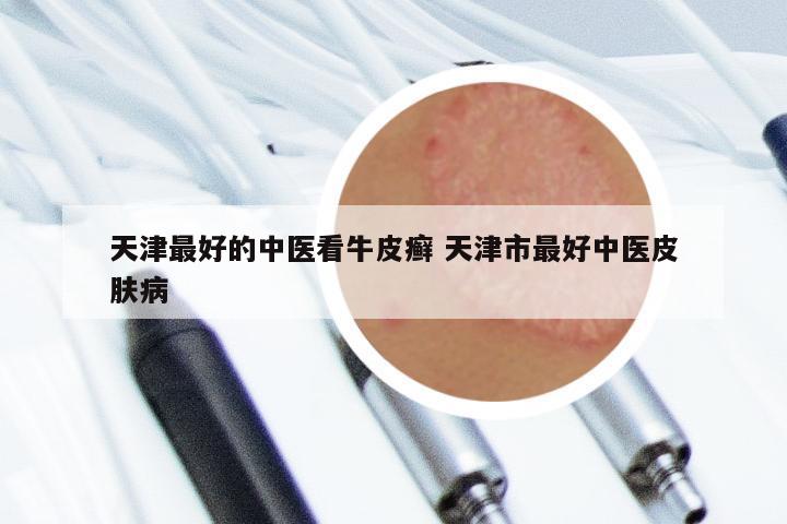 天津最好的中医看牛皮癣 天津市最好中医皮肤病