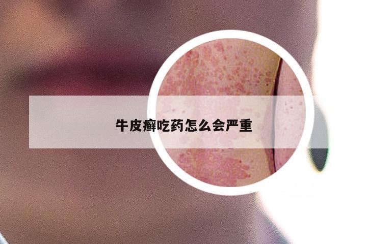 牛皮癣吃药怎么会严重