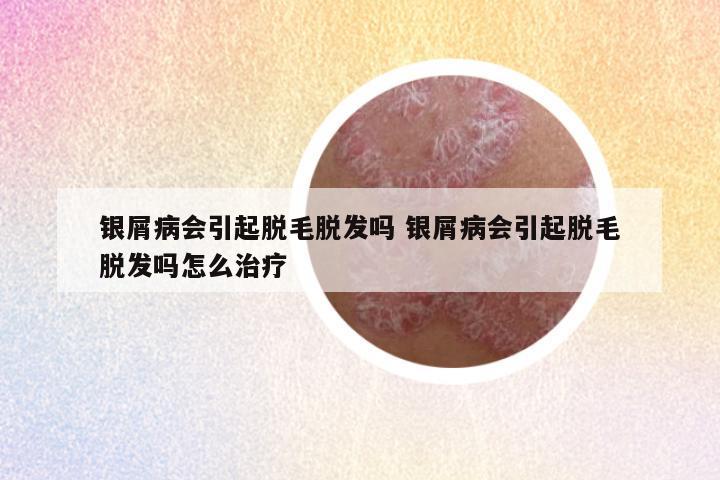 银屑病会引起脱毛脱发吗 银屑病会引起脱毛脱发吗怎么治疗