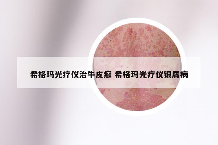 希格玛光疗仪治牛皮癣 希格玛光疗仪银屑病