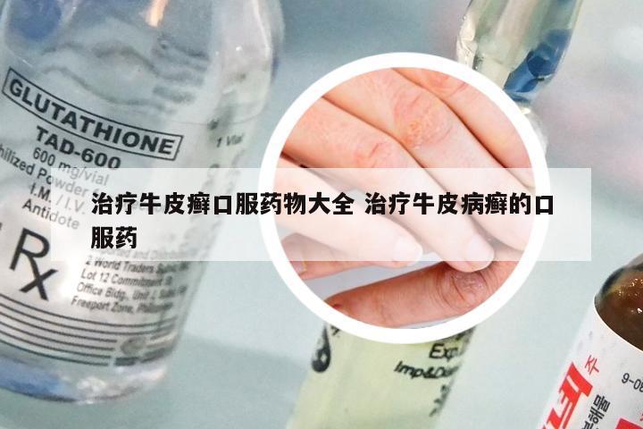 治疗牛皮癣口服药物大全 治疗牛皮病癣的口服药