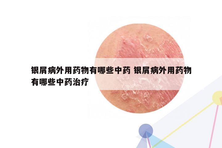 银屑病外用药物有哪些中药 银屑病外用药物有哪些中药治疗