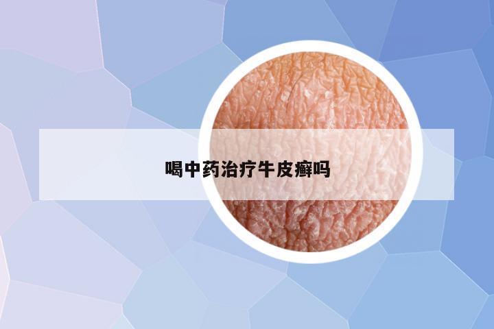 喝中药治疗牛皮癣吗