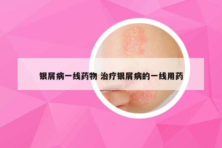 银屑病一线药物 治疗银屑病的一线用药