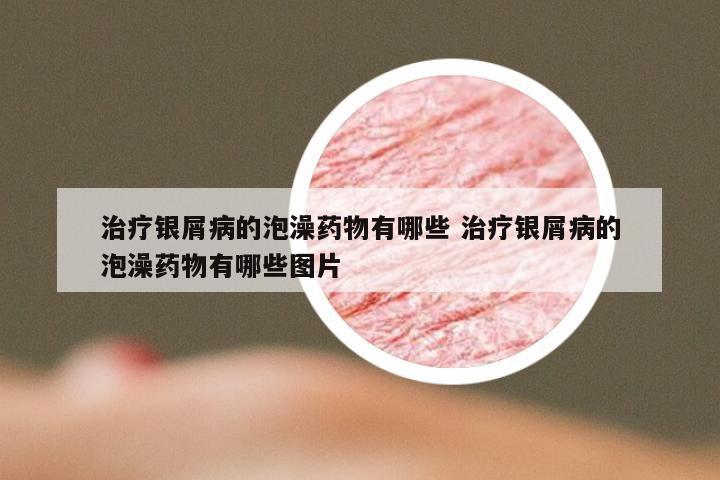 治疗银屑病的泡澡药物有哪些 治疗银屑病的泡澡药物有哪些图片