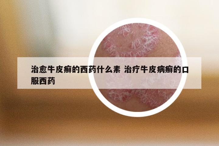 治愈牛皮癣的西药什么素 治疗牛皮病癣的口服西药