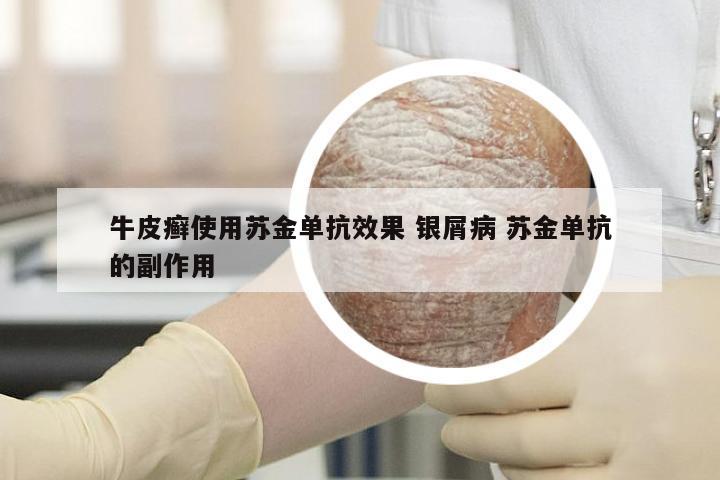 牛皮癣使用苏金单抗效果 银屑病 苏金单抗的副作用