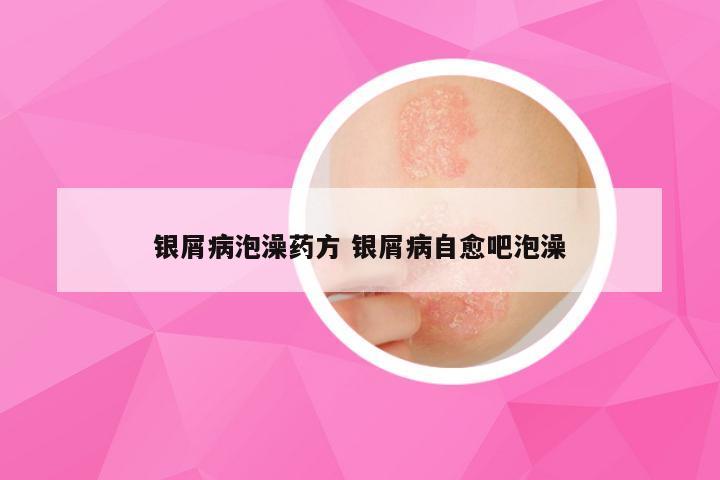 银屑病泡澡药方 银屑病自愈吧泡澡