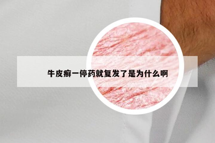 牛皮癣一停药就复发了是为什么啊