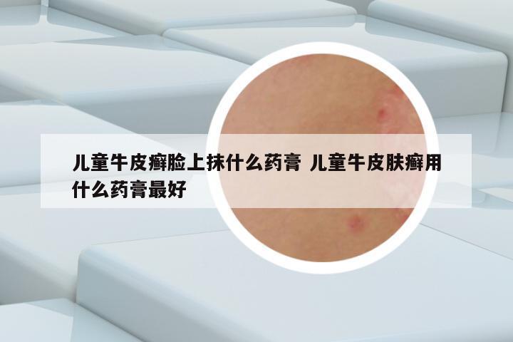 儿童牛皮癣脸上抹什么药膏 儿童牛皮肤癣用什么药膏最好