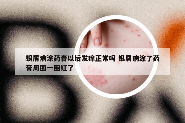 银屑病涂药膏以后发痒正常吗 银屑病涂了药膏周围一圈红了