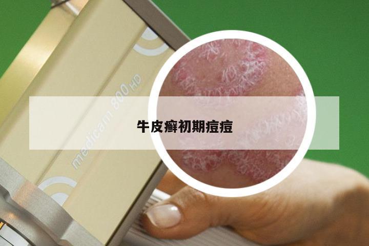 牛皮癣初期痘痘