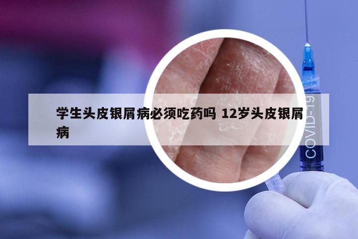 学生头皮银屑病必须吃药吗 12岁头皮银屑病