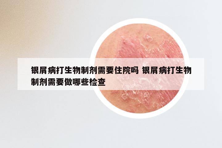 银屑病打生物制剂需要住院吗 银屑病打生物制剂需要做哪些检查