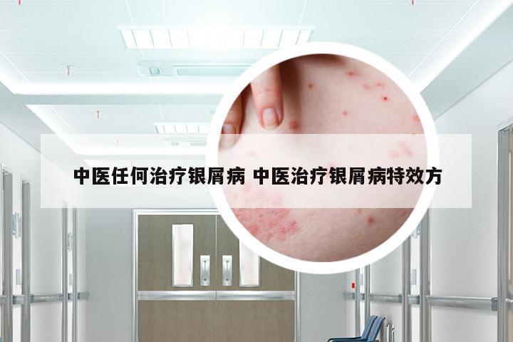 中医任何治疗银屑病 中医治疗银屑病特效方
