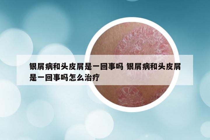 银屑病和头皮屑是一回事吗 银屑病和头皮屑是一回事吗怎么治疗
