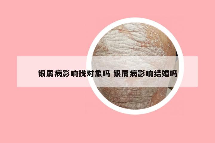 银屑病影响找对象吗 银屑病影响结婚吗