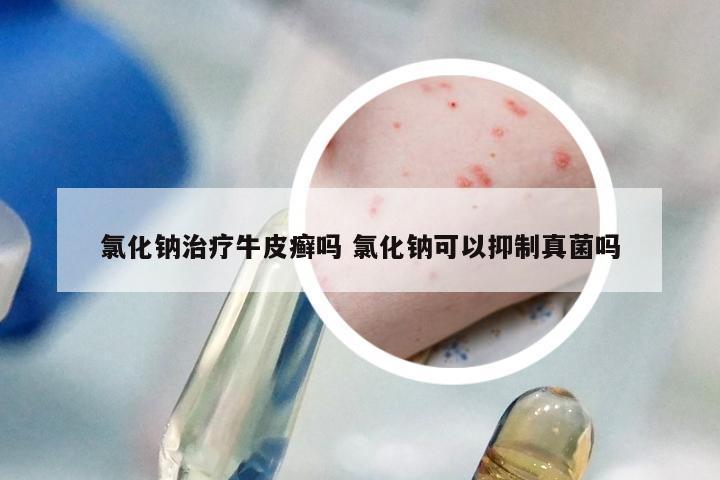 氯化钠治疗牛皮癣吗 氯化钠可以抑制真菌吗
