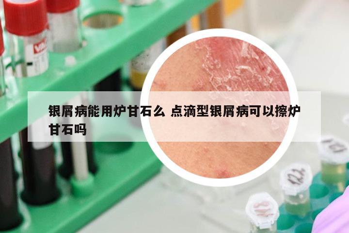 银屑病能用炉甘石么 点滴型银屑病可以擦炉甘石吗