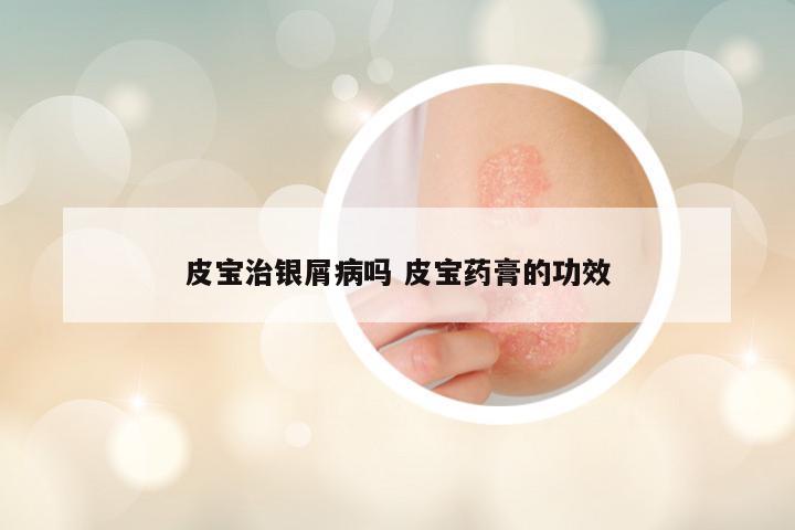 皮宝治银屑病吗 皮宝药膏的功效