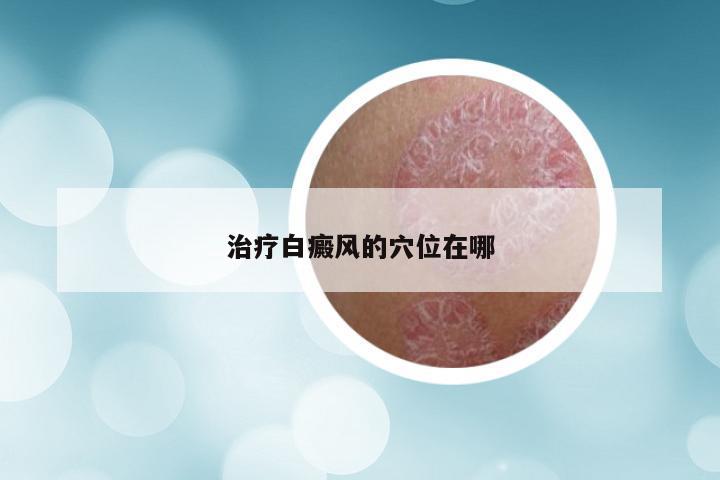 治疗白癜风的穴位在哪