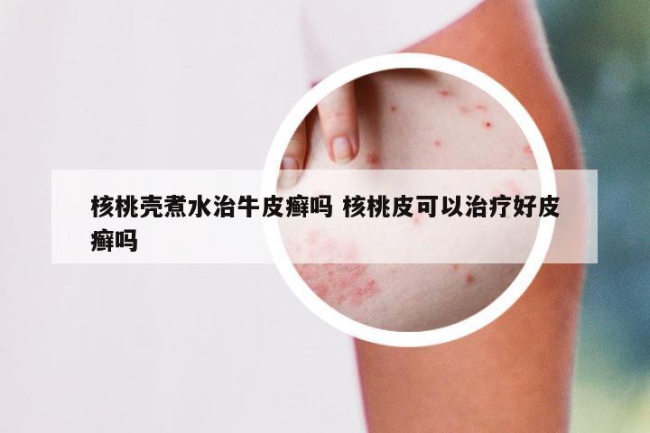 核桃壳煮水治牛皮癣吗 核桃皮可以治疗好皮癣吗