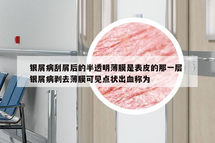银屑病刮屑后的半透明薄膜是表皮的那一层 银屑病剥去薄膜可见点状出血称为