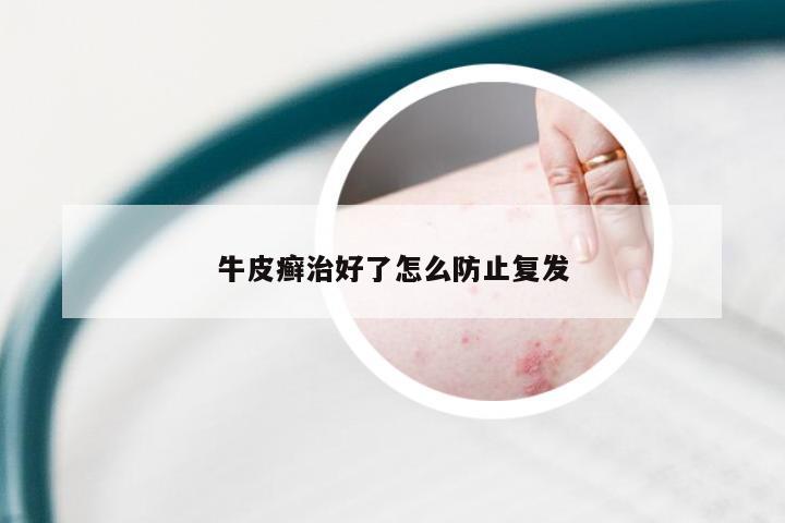 牛皮癣治好了怎么防止复发
