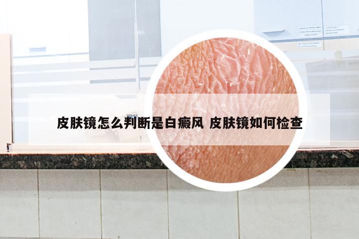 皮肤镜怎么判断是白癜风 皮肤镜如何检查