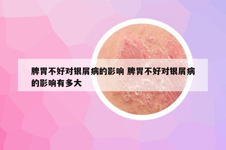 脾胃不好对银屑病的影响 脾胃不好对银屑病的影响有多大