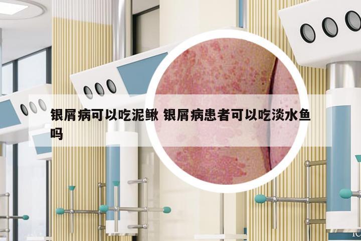 银屑病可以吃泥鳅 银屑病患者可以吃淡水鱼吗