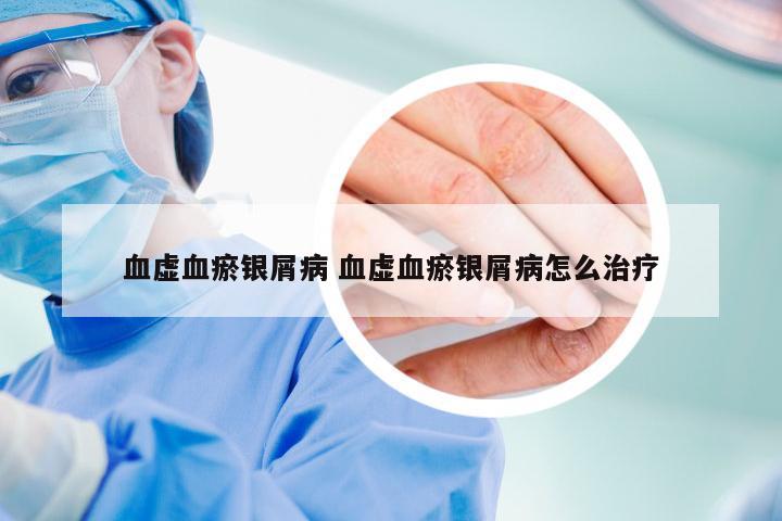 血虚血瘀银屑病 血虚血瘀银屑病怎么治疗