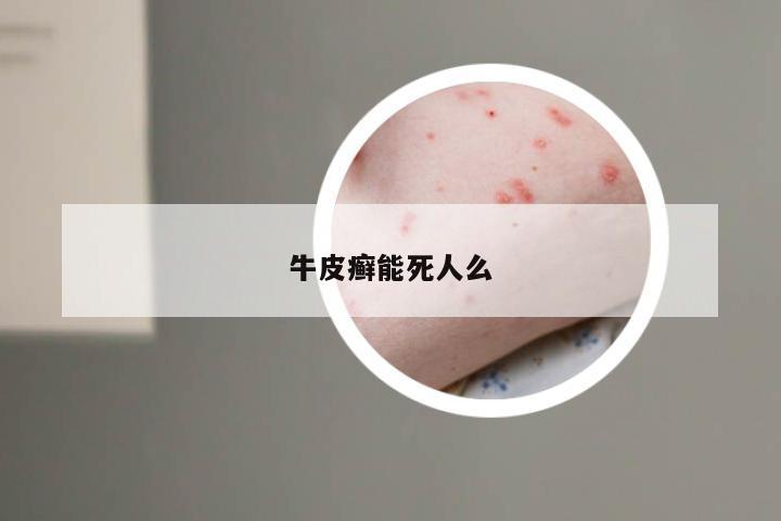 牛皮癣能死人么