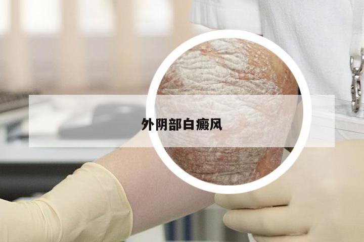 外阴部白癜风