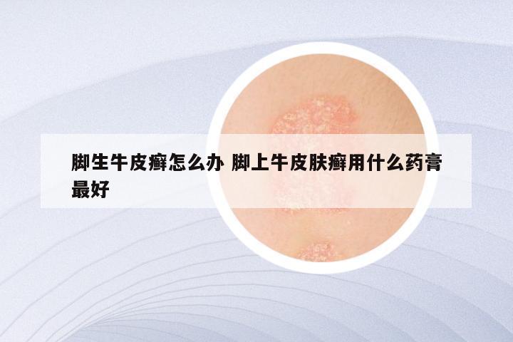 脚生牛皮癣怎么办 脚上牛皮肤癣用什么药膏最好