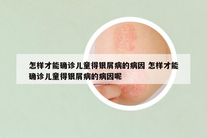怎样才能确诊儿童得银屑病的病因 怎样才能确诊儿童得银屑病的病因呢