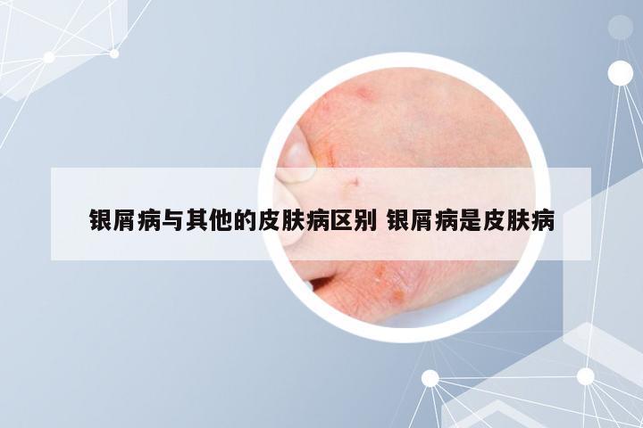 银屑病与其他的皮肤病区别 银屑病是皮肤病