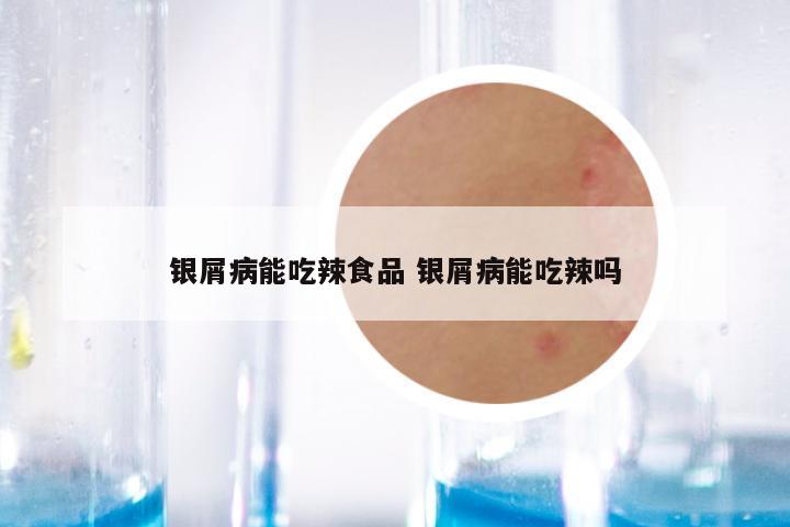 银屑病能吃辣食品 银屑病能吃辣吗