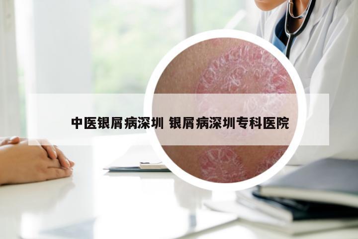 中医银屑病深圳 银屑病深圳专科医院