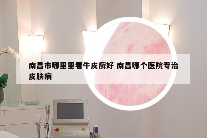 南昌市哪里里看牛皮癣好 南昌哪个医院专治皮肤病