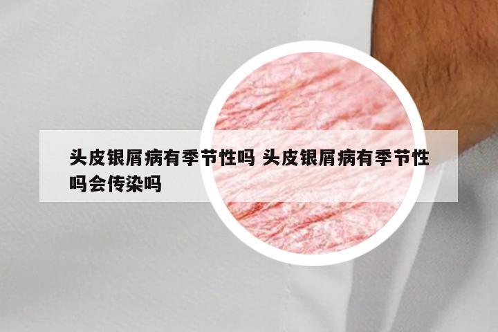 头皮银屑病有季节性吗 头皮银屑病有季节性吗会传染吗