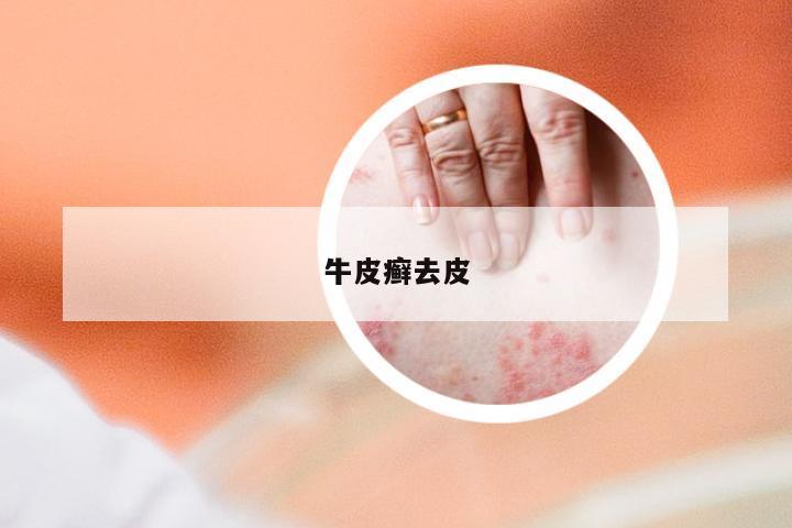 牛皮癣去皮