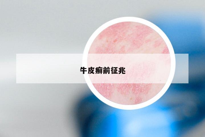 牛皮癣前征兆