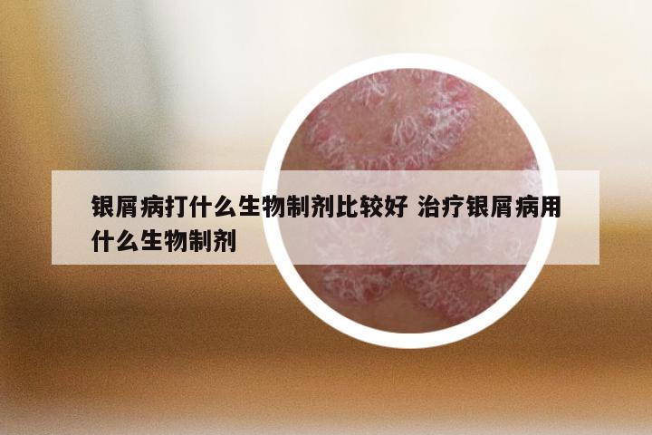 银屑病打什么生物制剂比较好 治疗银屑病用什么生物制剂