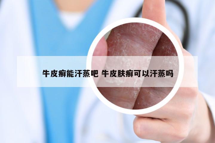 牛皮癣能汗蒸吧 牛皮肤癣可以汗蒸吗