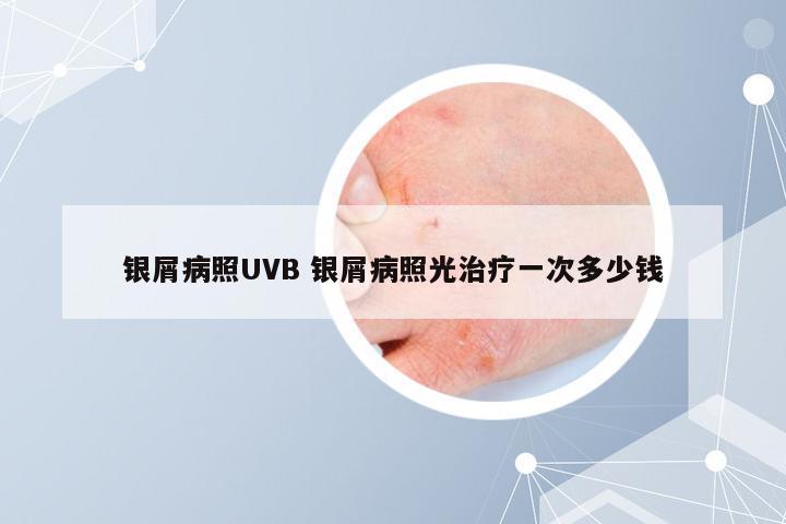 银屑病照UVB 银屑病照光治疗一次多少钱