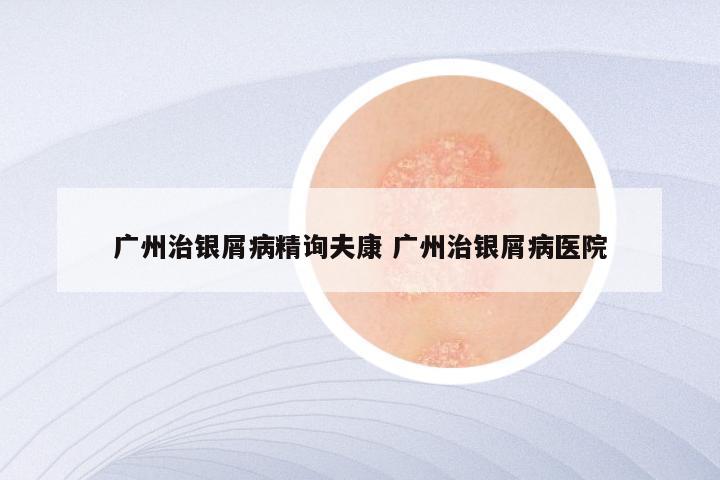 广州治银屑病精询夫康 广州治银屑病医院